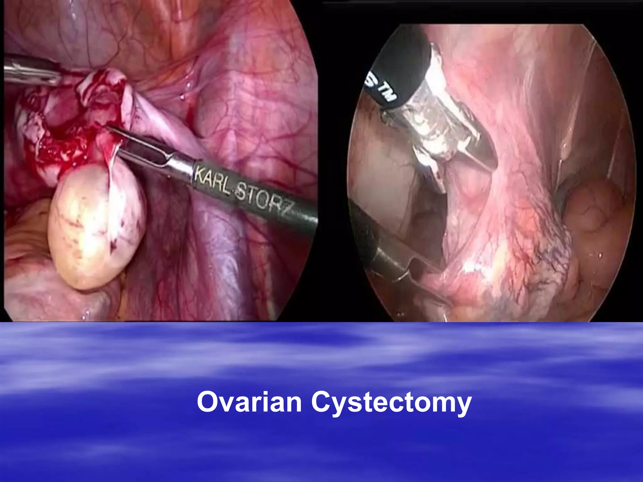 Ovarian Cystectomy
 