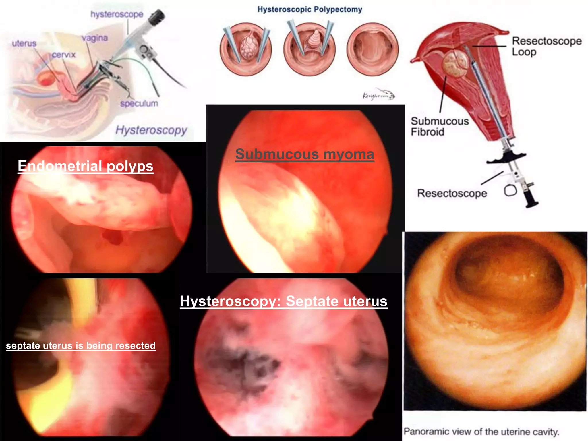Submucous myoma
Endometrial polyps
Hysteroscopy: Septate uterus
septate uterus is being resected
 