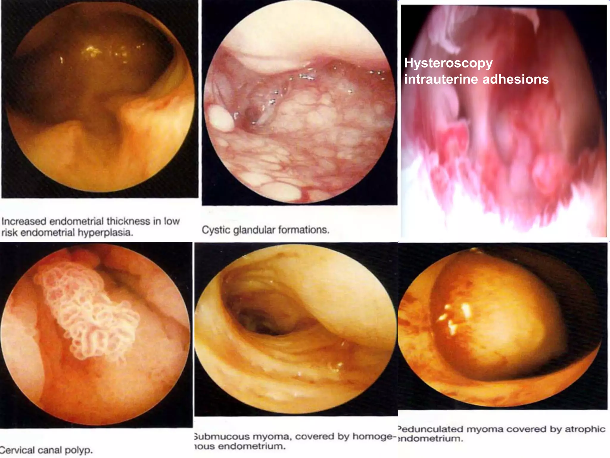 Hysteroscopy
intrauterine adhesions
 
