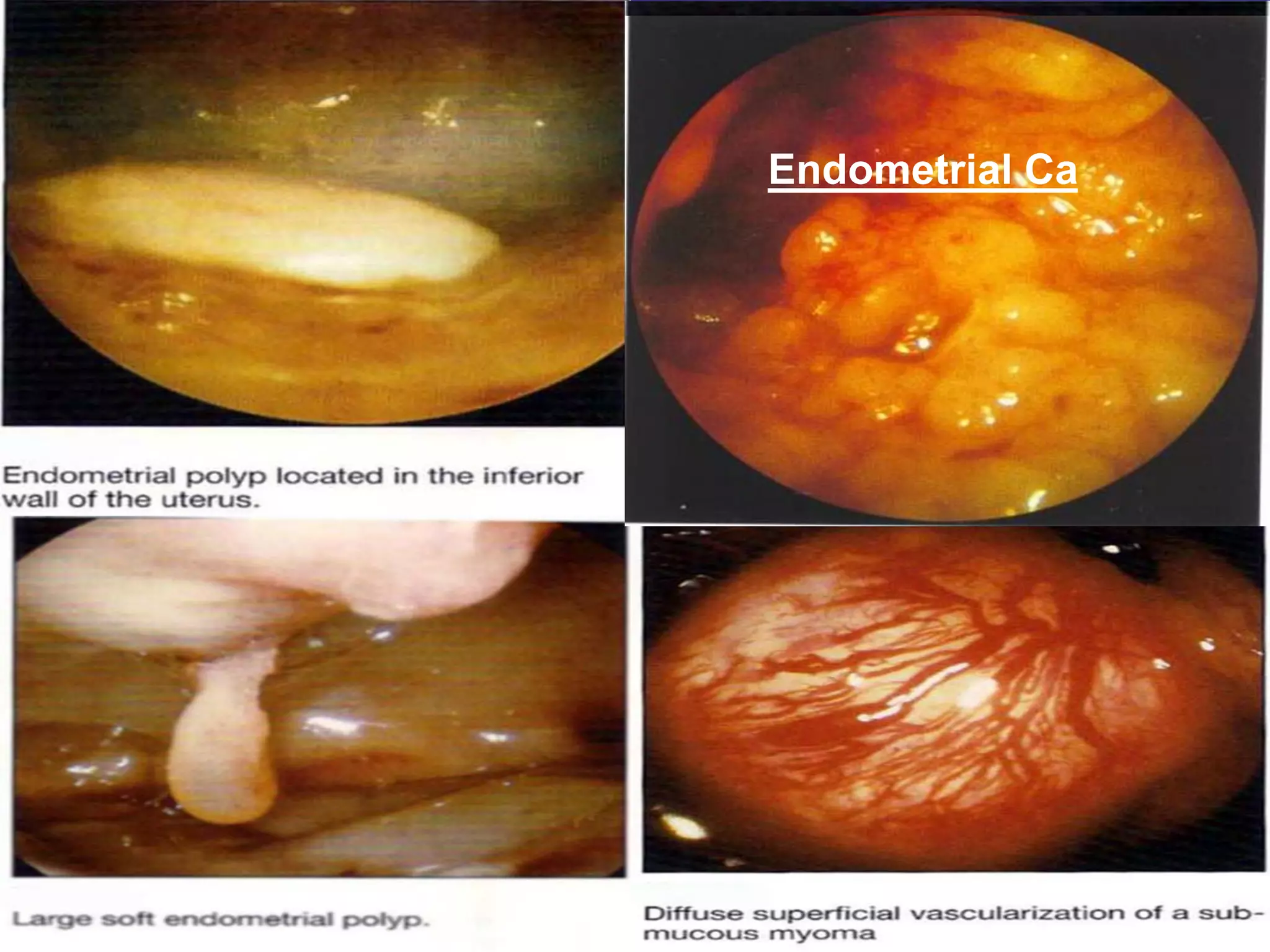 Endometrial Ca
 