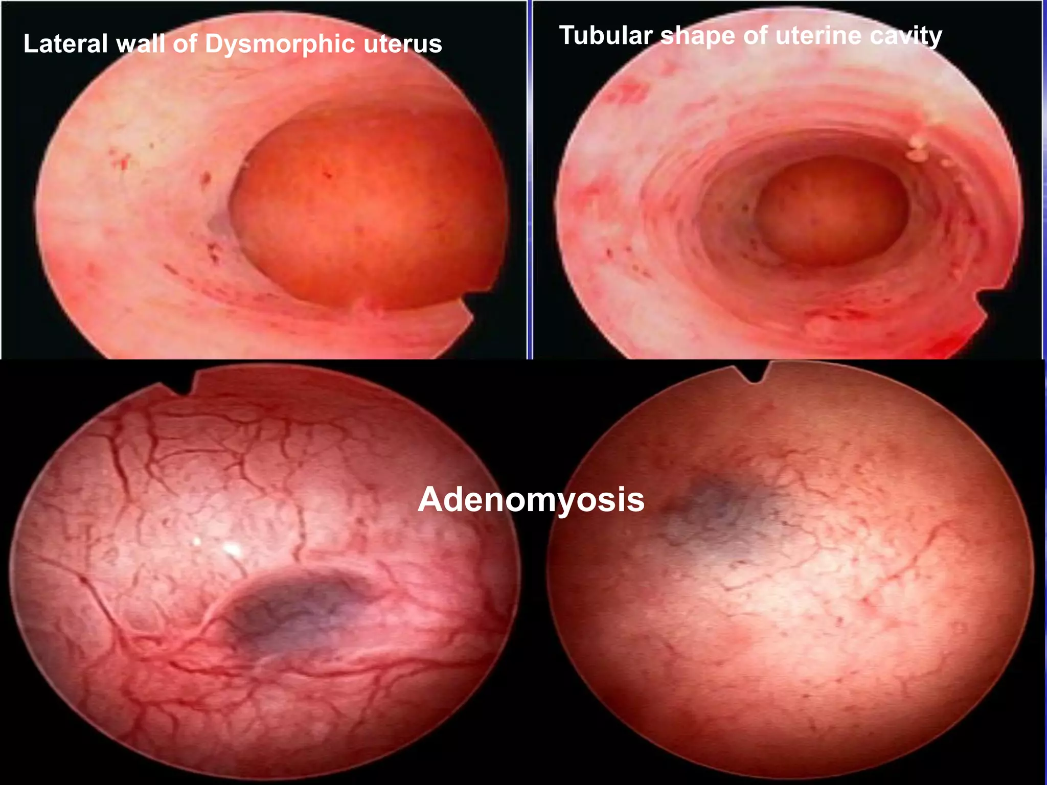 Adenomyosis
Lateral wall of Dysmorphic uterus Tubular shape of uterine cavity
 