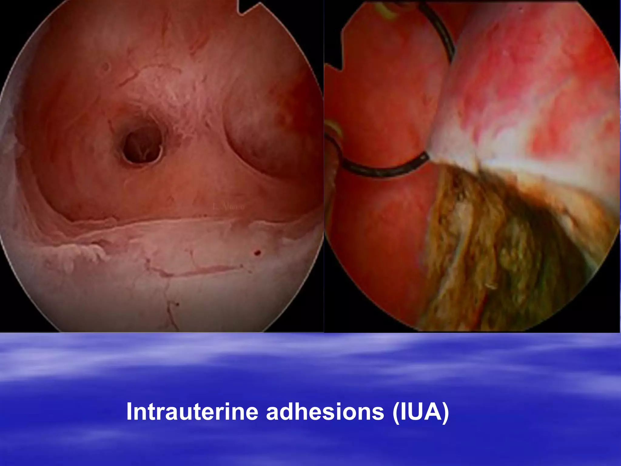 Intrauterine adhesions (IUA)
 