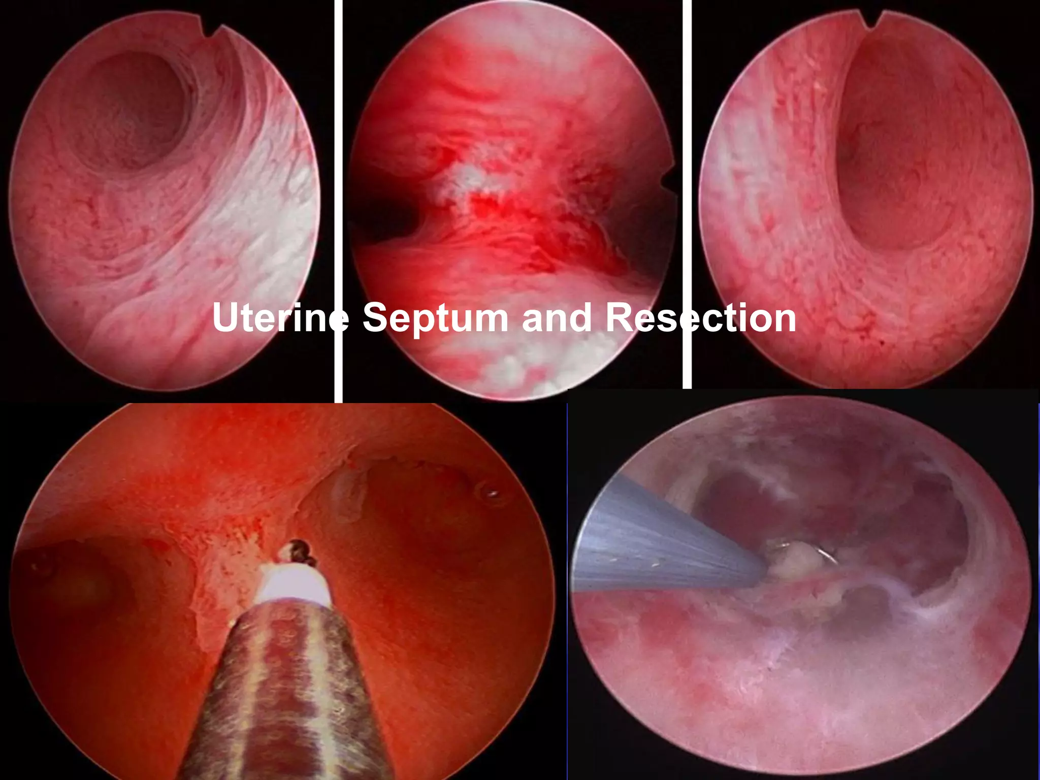 Uterine Septum and Resection
 