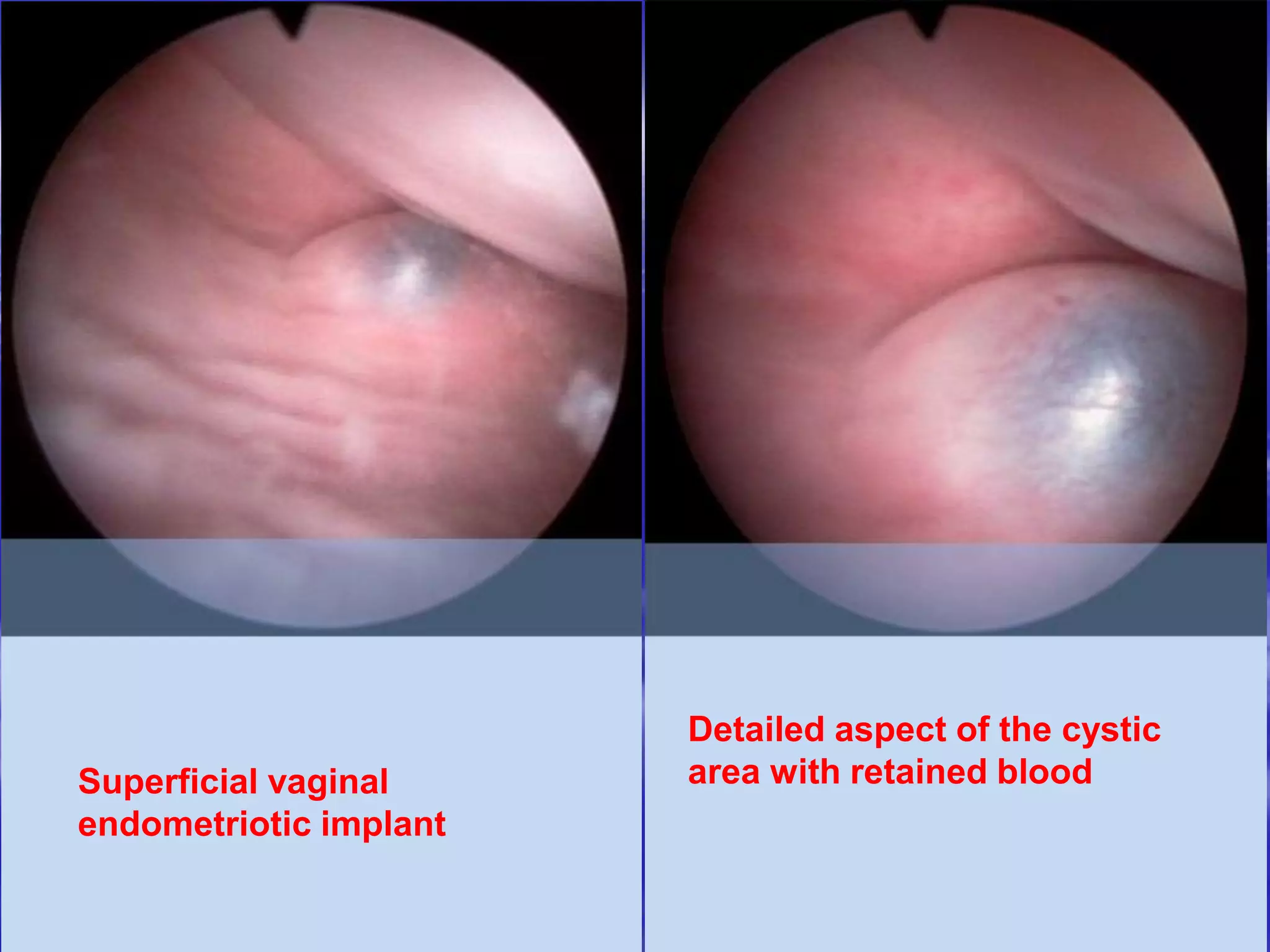Superficial vaginal
endometriotic implant
Detailed aspect of the cystic
area with retained blood
 