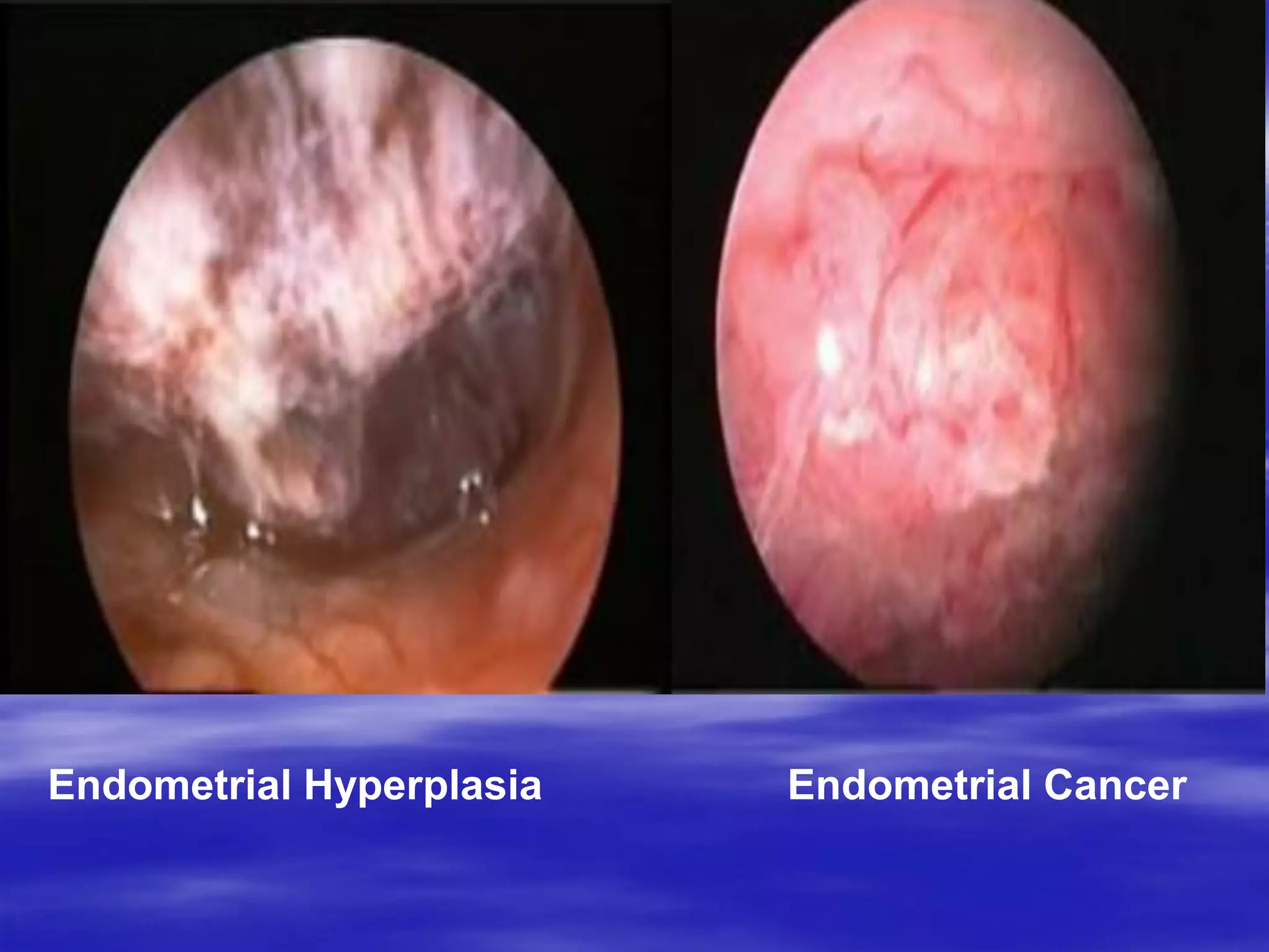 Endometrial CancerEndometrial Hyperplasia
 