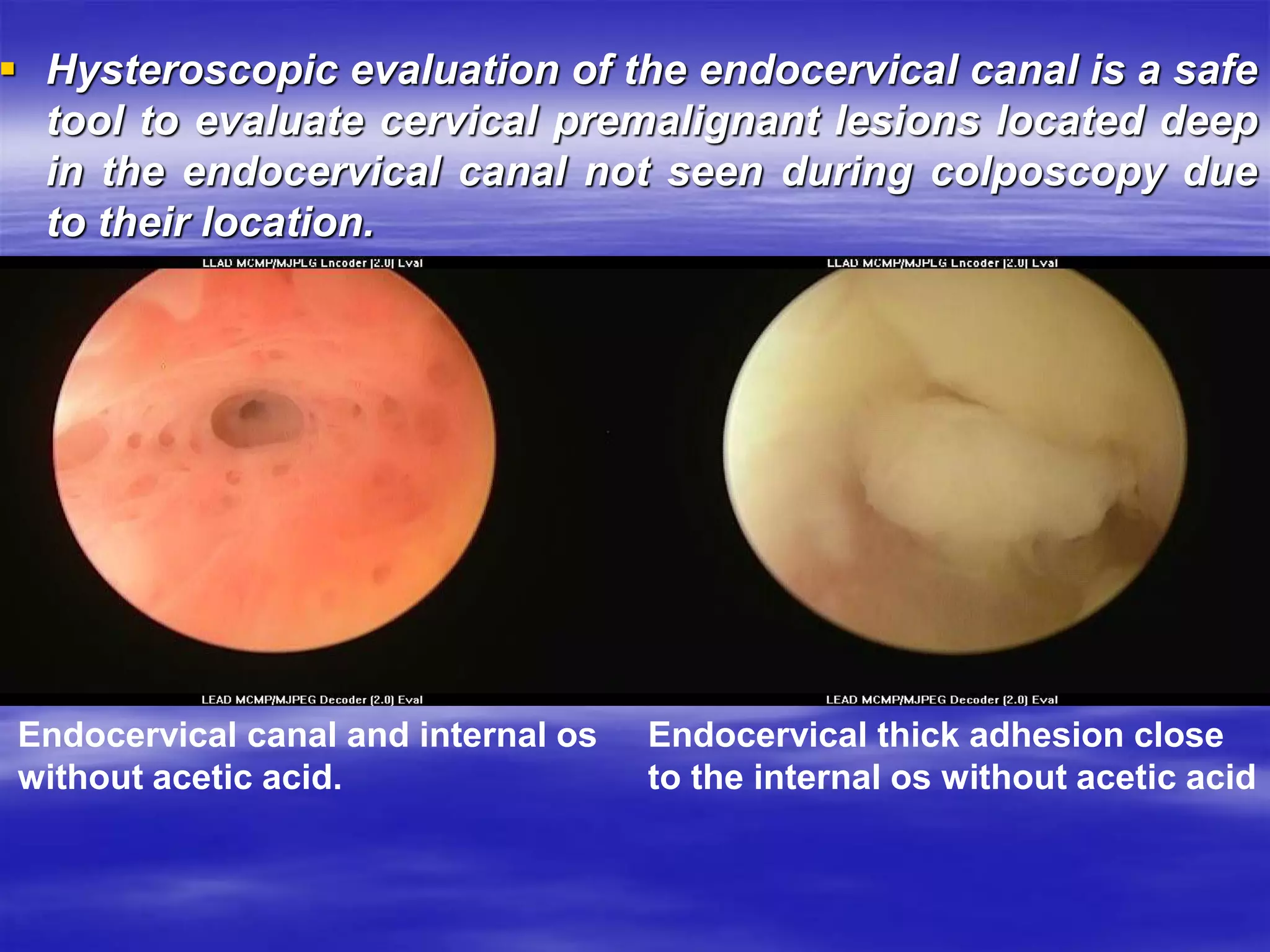  Hysteroscopic evaluation of the endocervical canal is a safe
tool to evaluate cervical premalignant lesions located deep
in the endocervical canal not seen during colposcopy due
to their location.
Endocervical canal and internal os
without acetic acid.
Endocervical thick adhesion close
to the internal os without acetic acid
 