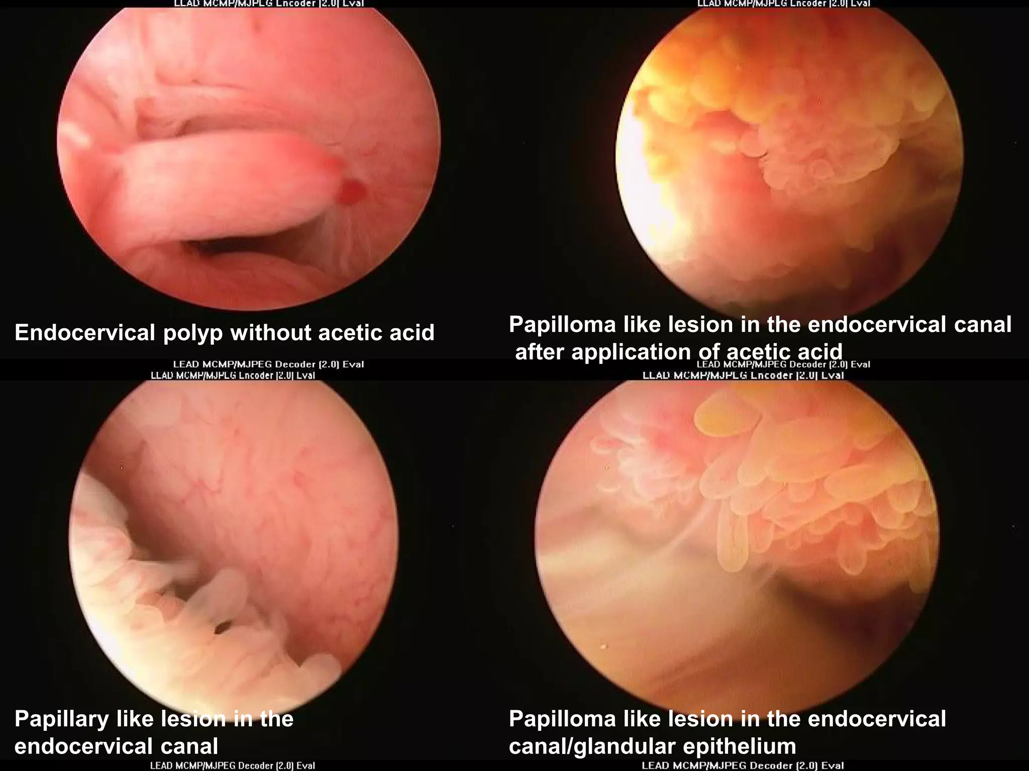 Endocervical polyp without acetic acid Papilloma like lesion in the endocervical canal
after application of acetic acid
Papillary like lesion in the
endocervical canal
Papilloma like lesion in the endocervical
canal/glandular epithelium
 