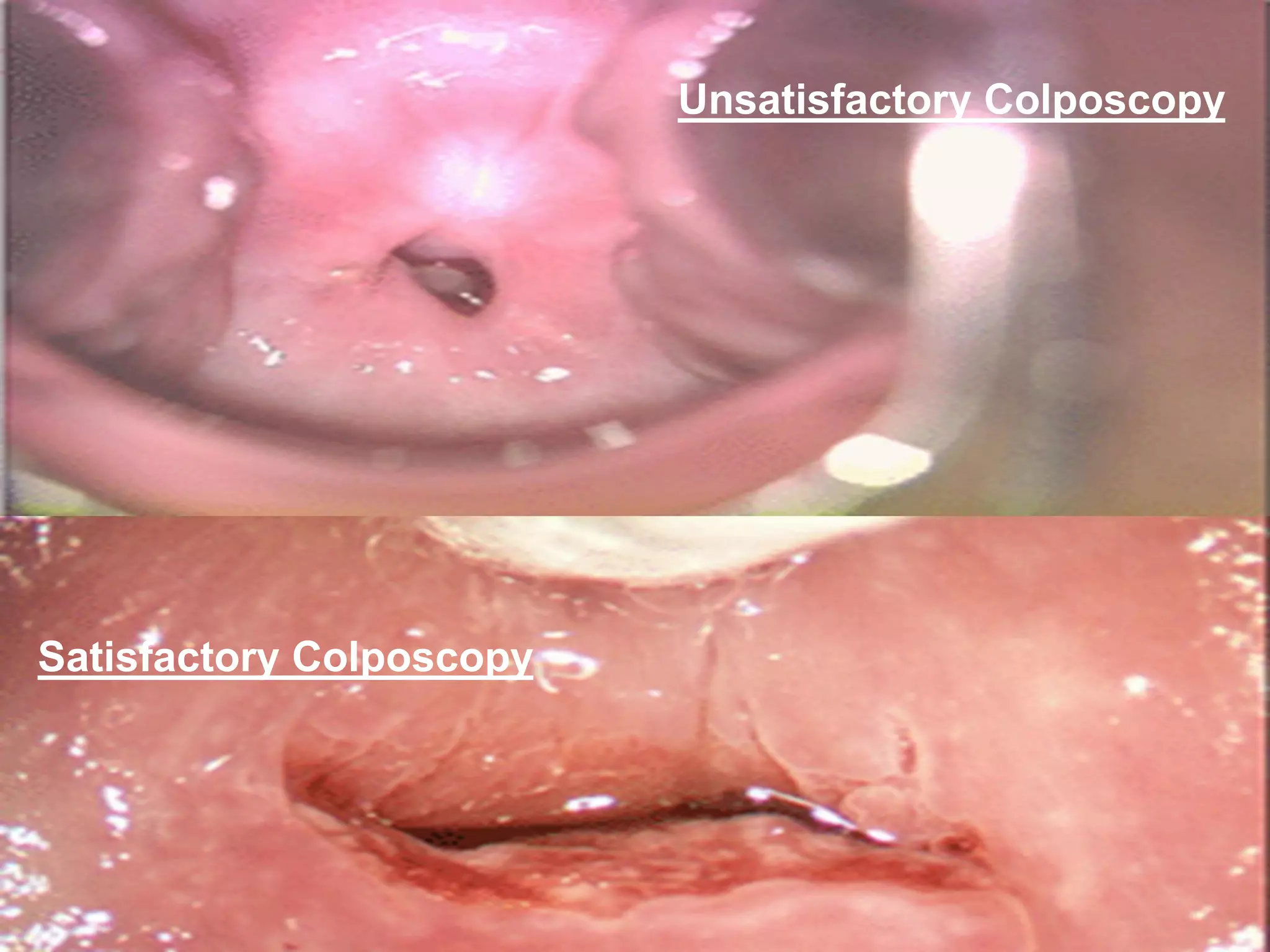 Unsatisfactory Colposcopy
Satisfactory Colposcopy
 