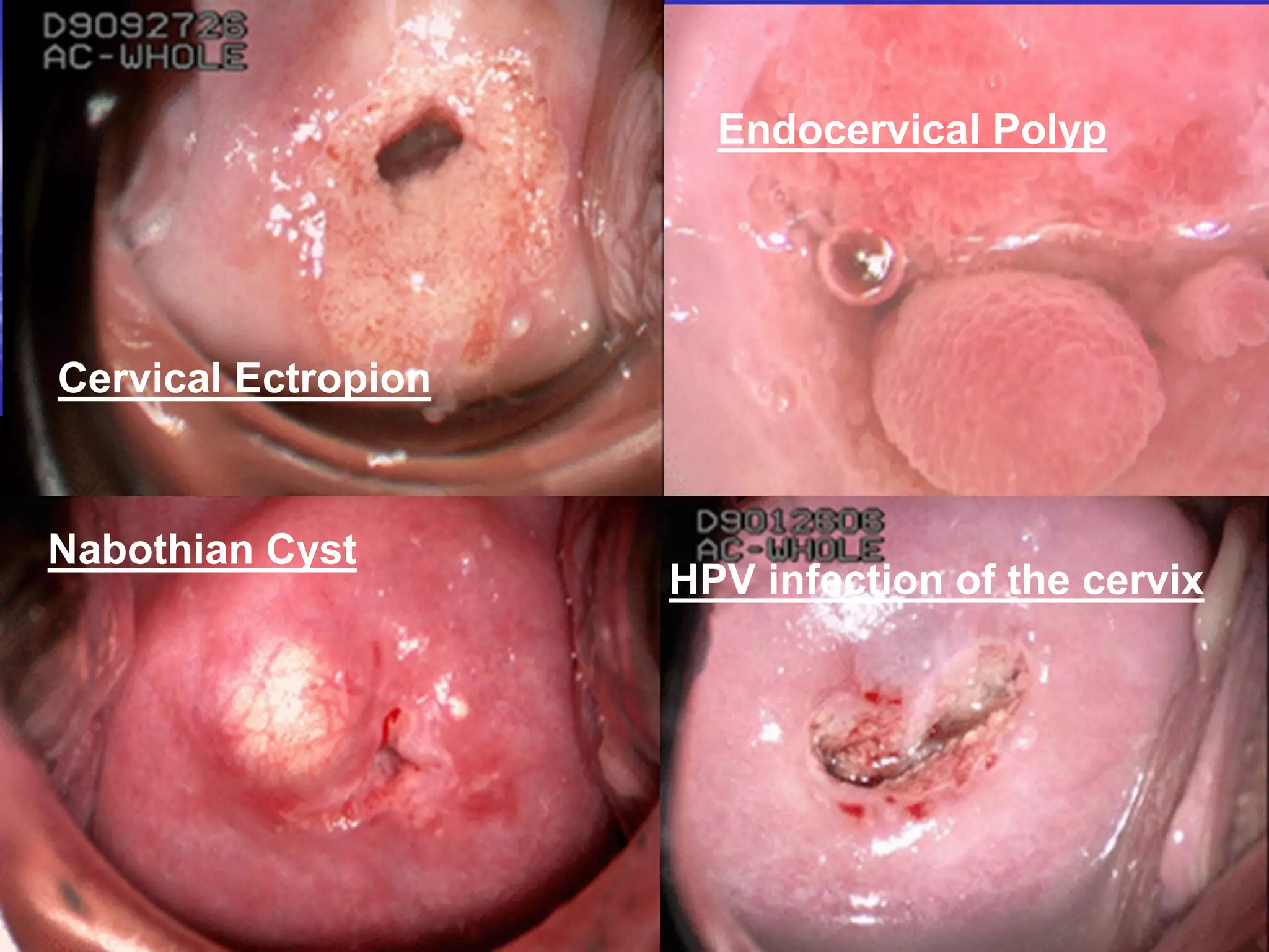 Cervical Ectropion
Nabothian Cyst
Endocervical Polyp
HPV infection of the cervix
 