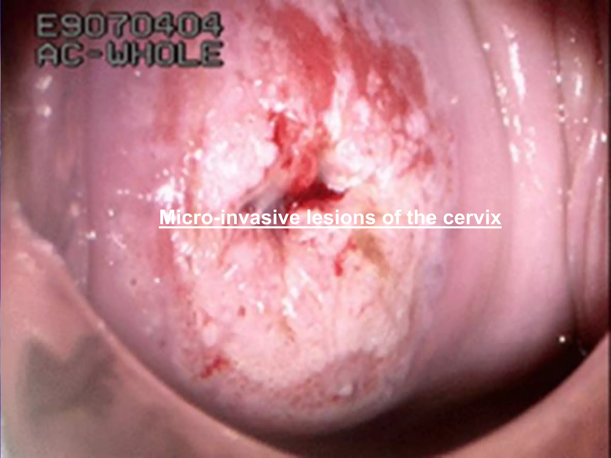 Micro-invasive lesions of the cervix
 