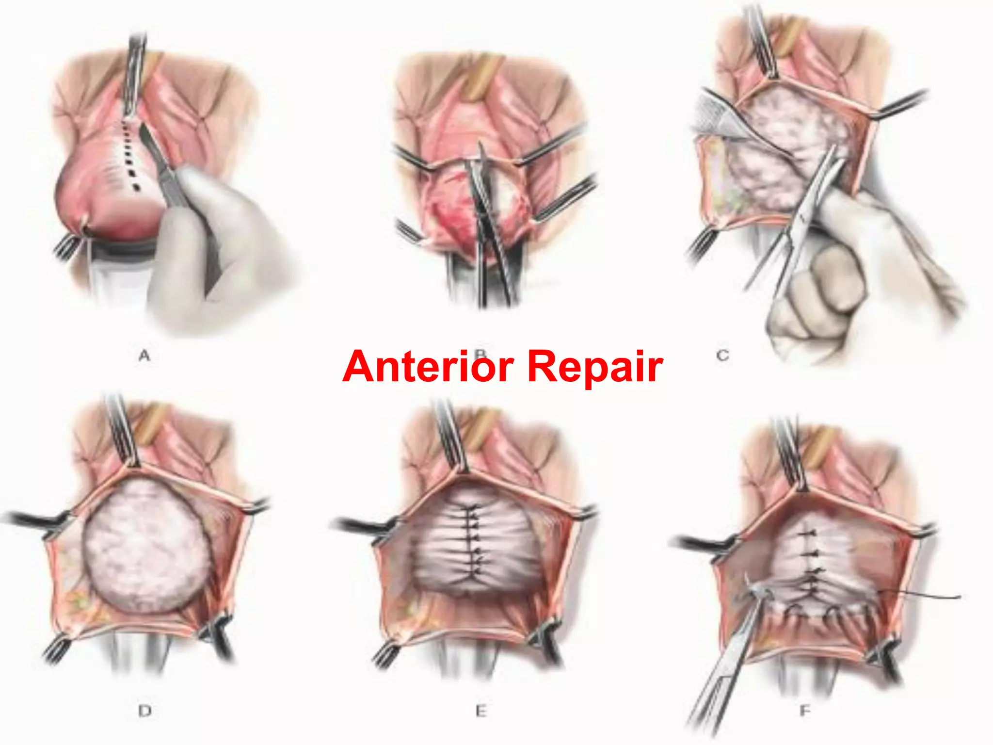 Anterior Repair
 