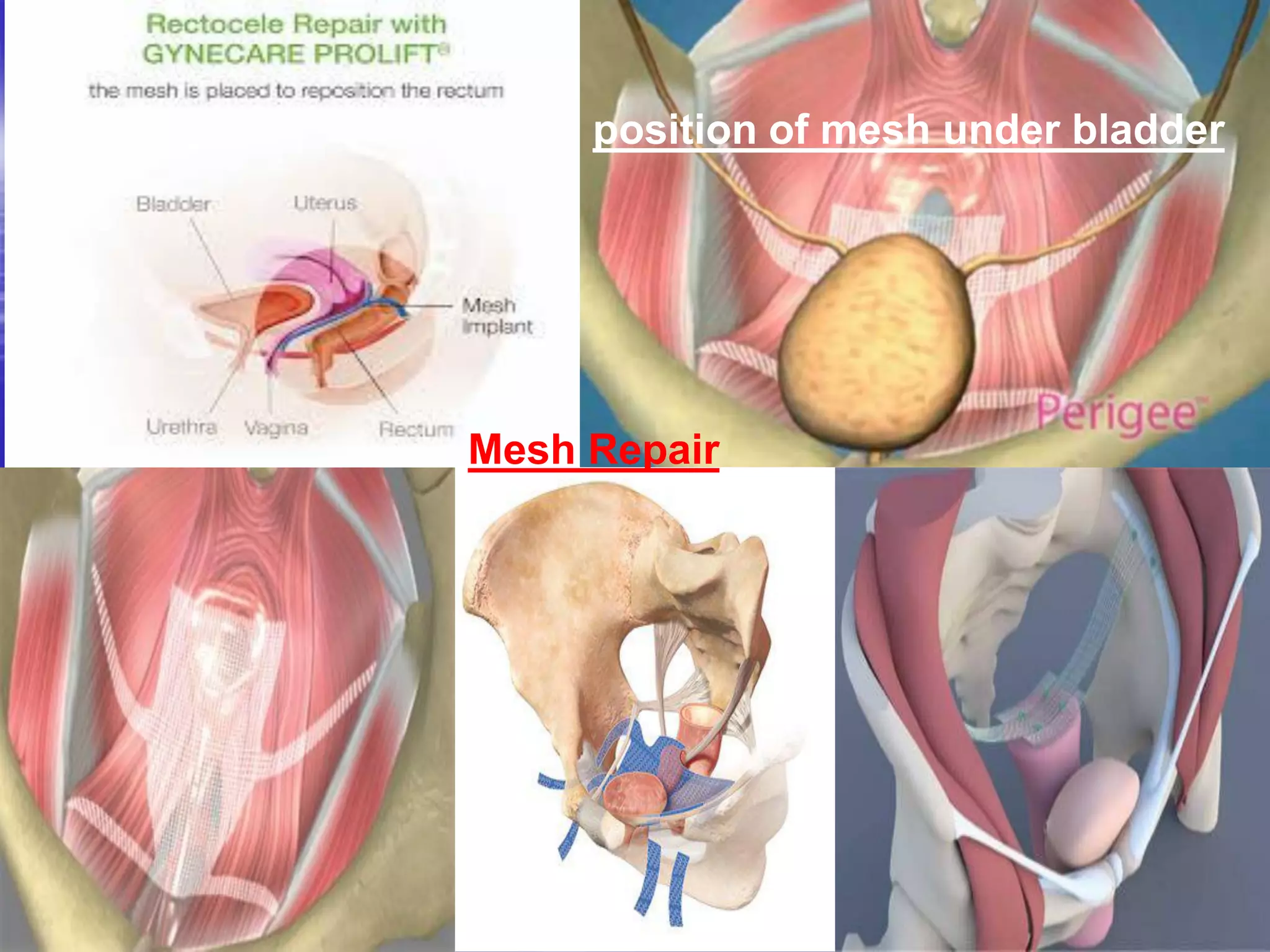 Mesh Repair
position of mesh under bladder
 