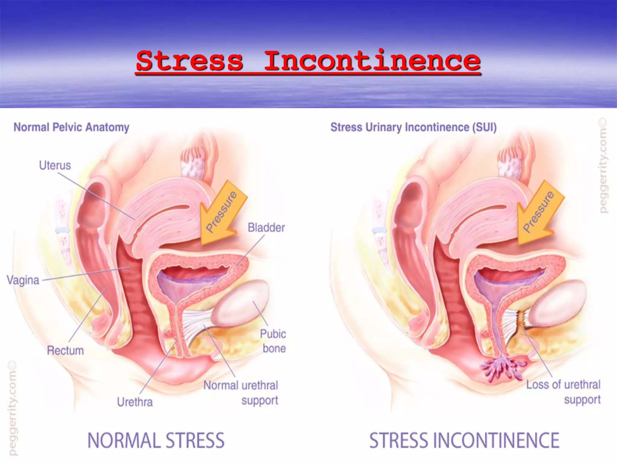 Stress Incontinence
 