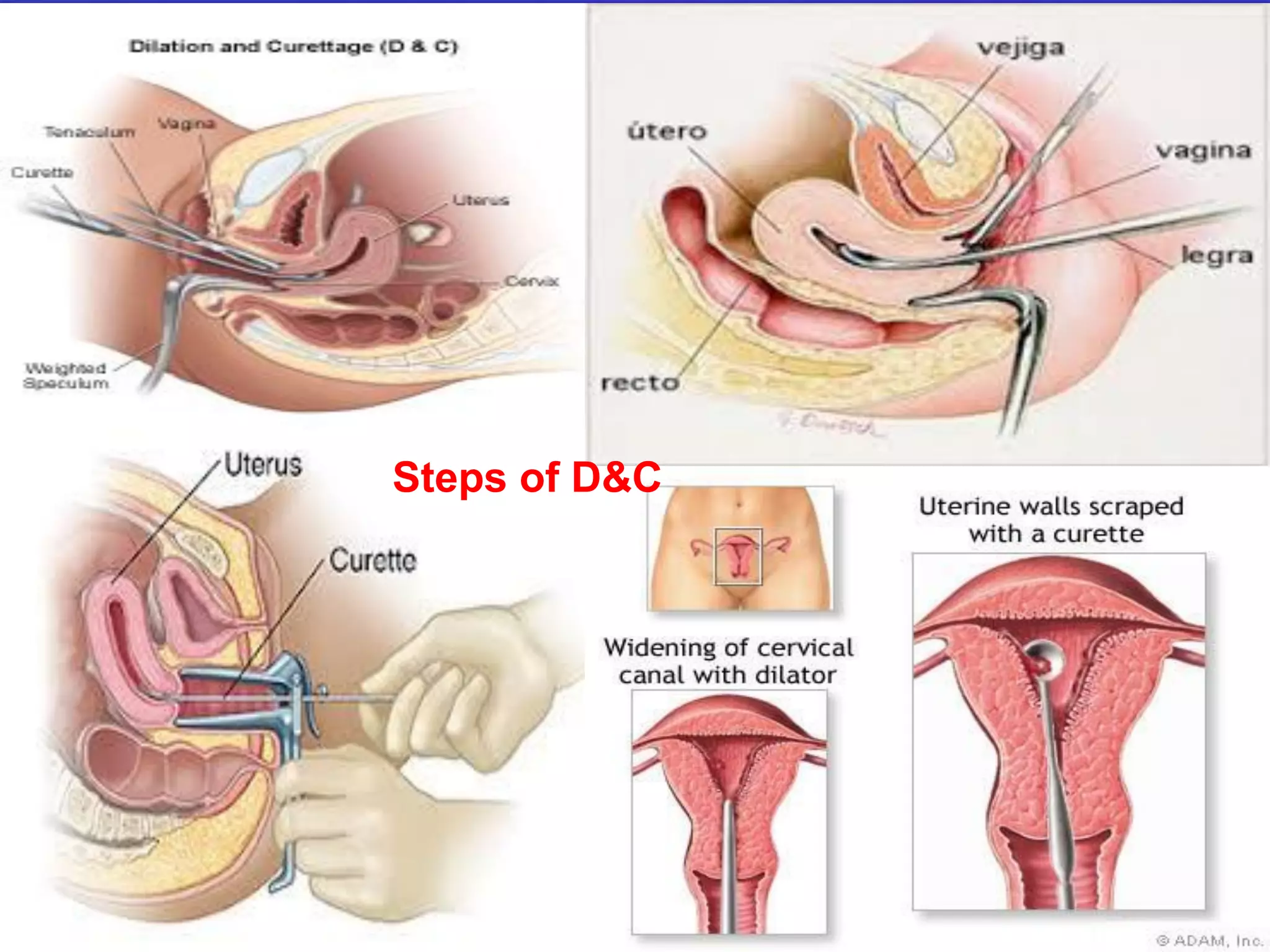 Steps of D&C
 