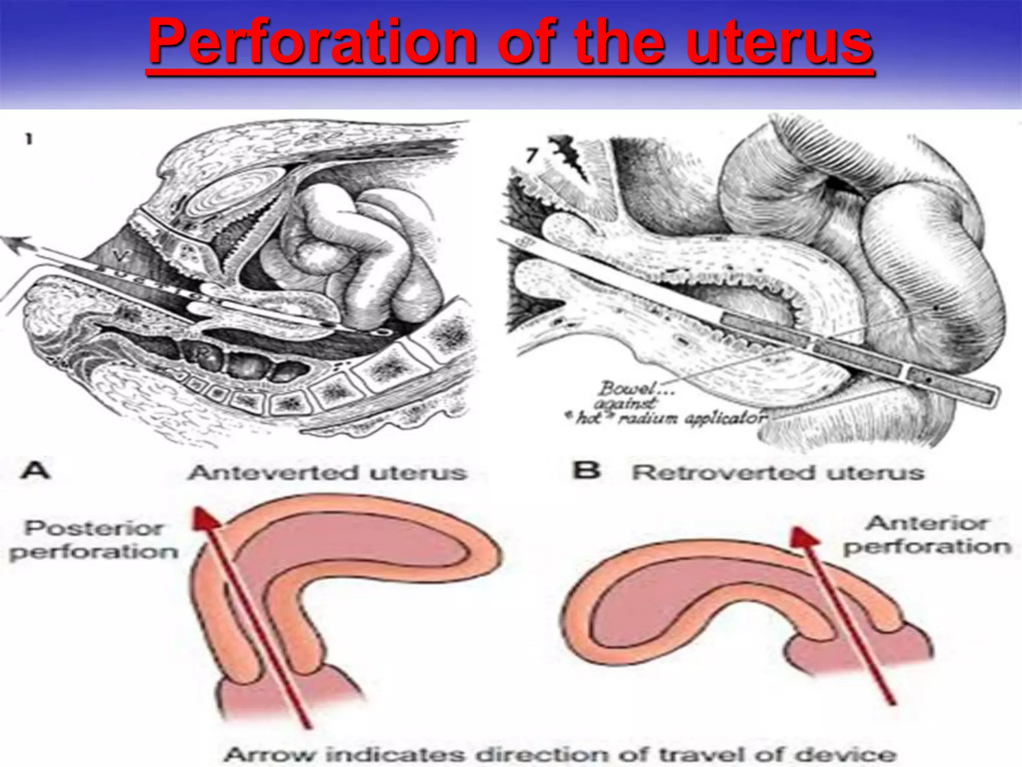 Perforation of the uterus
 