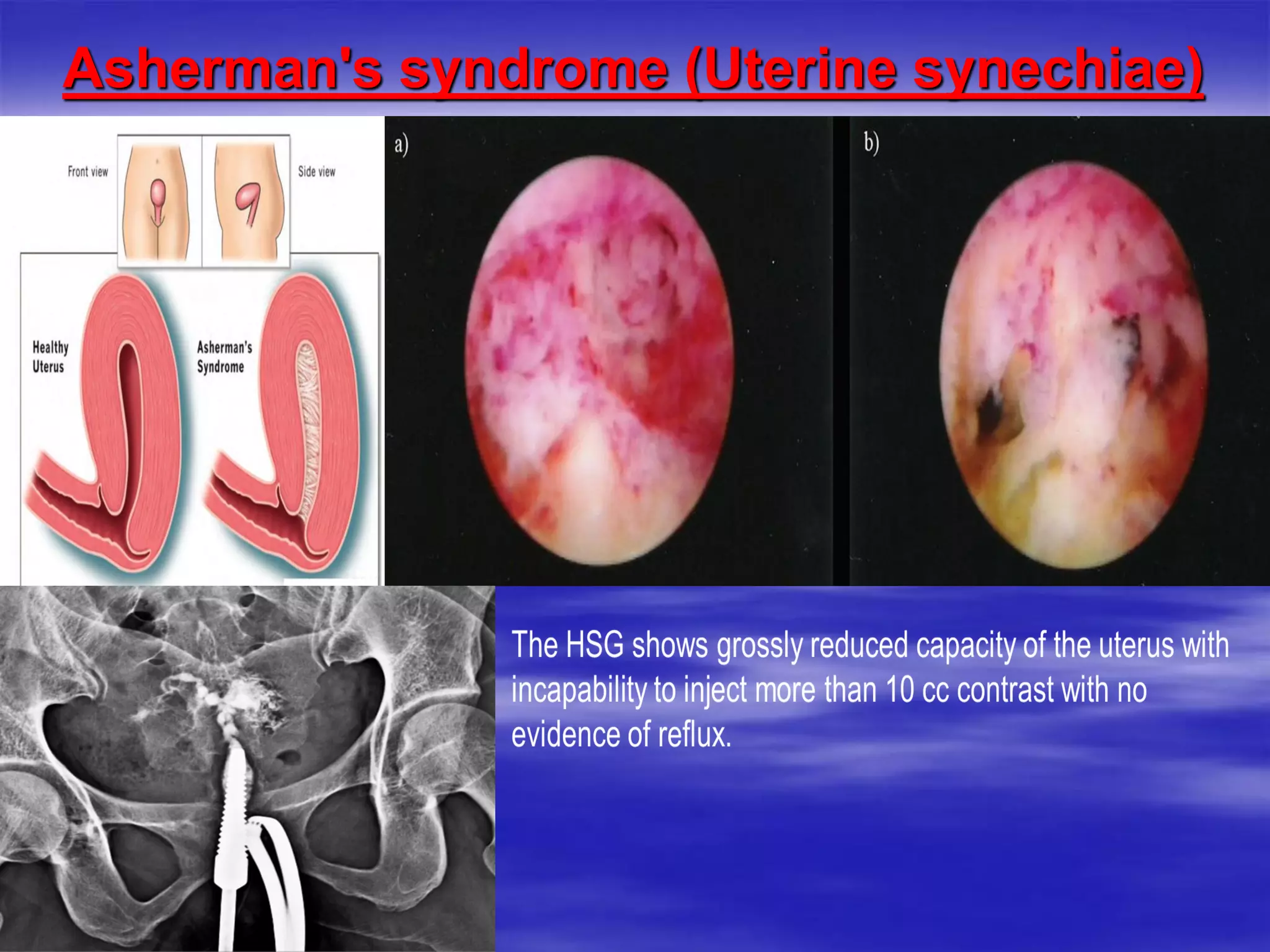 Asherman's syndrome (Uterine synechiae)
 