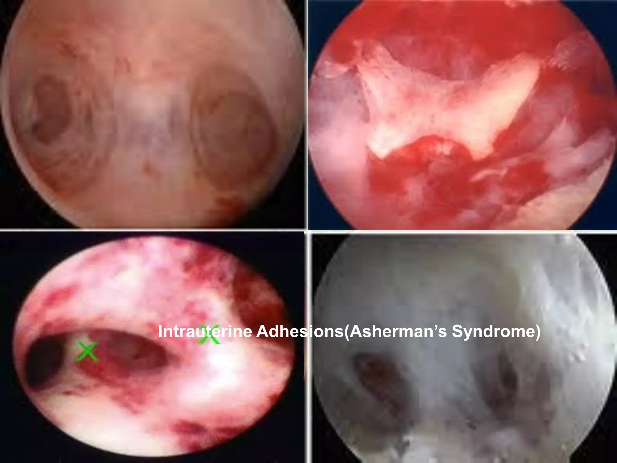 Intrauterine Adhesions(Asherman’s Syndrome)
 