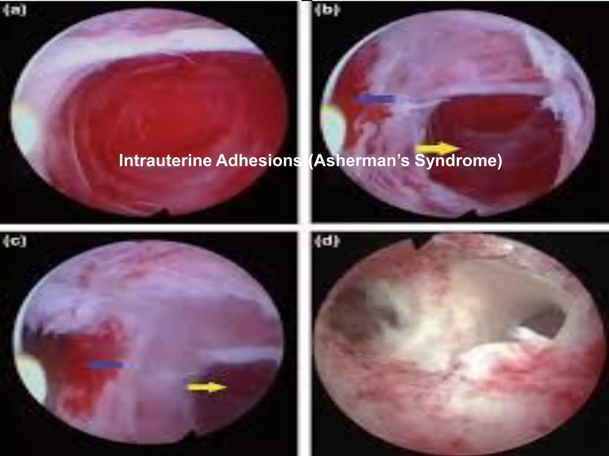 Intrauterine Adhesions((Asherman’s Syndrome)
 