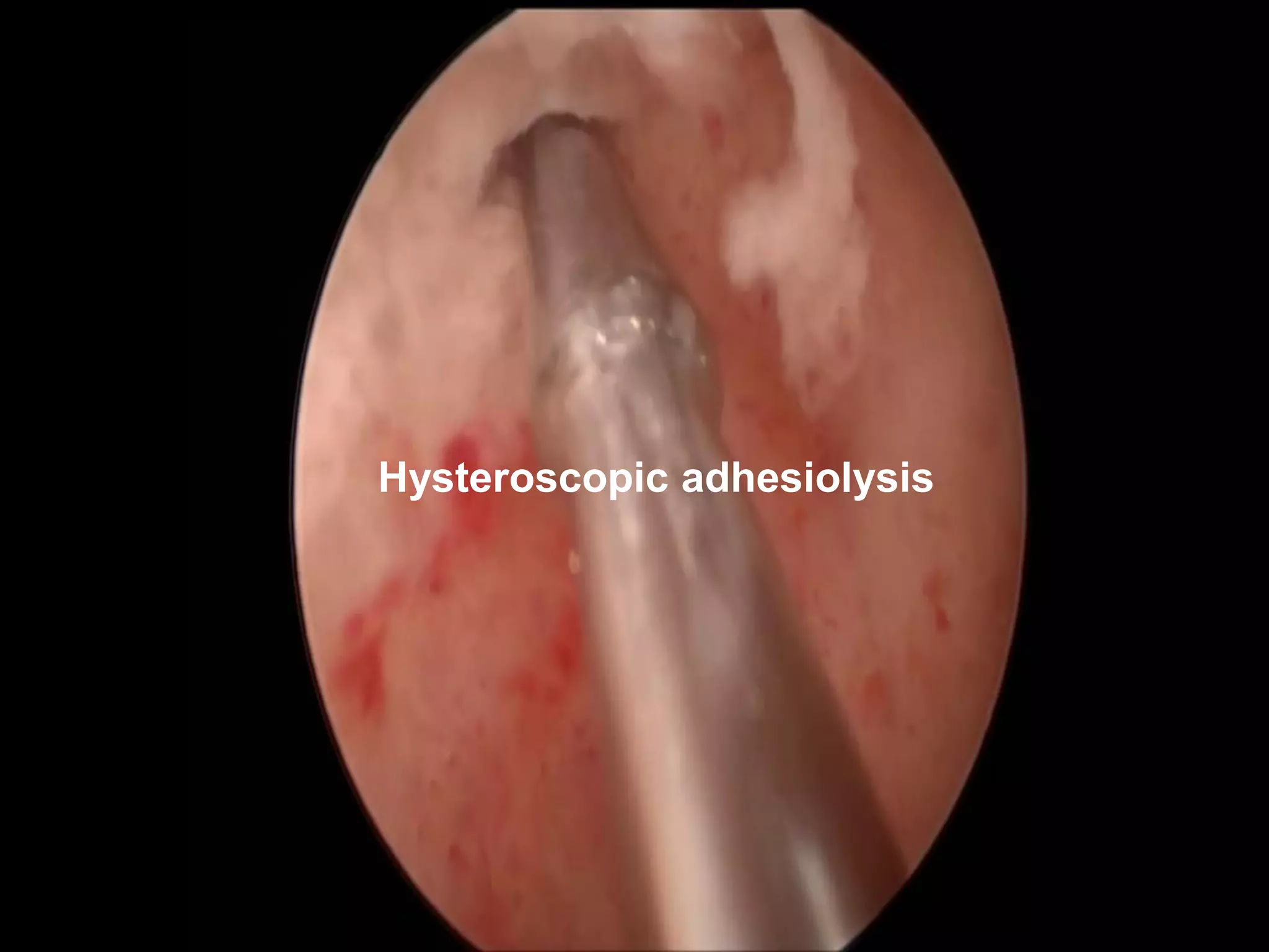 Hysteroscopic adhesiolysis
 