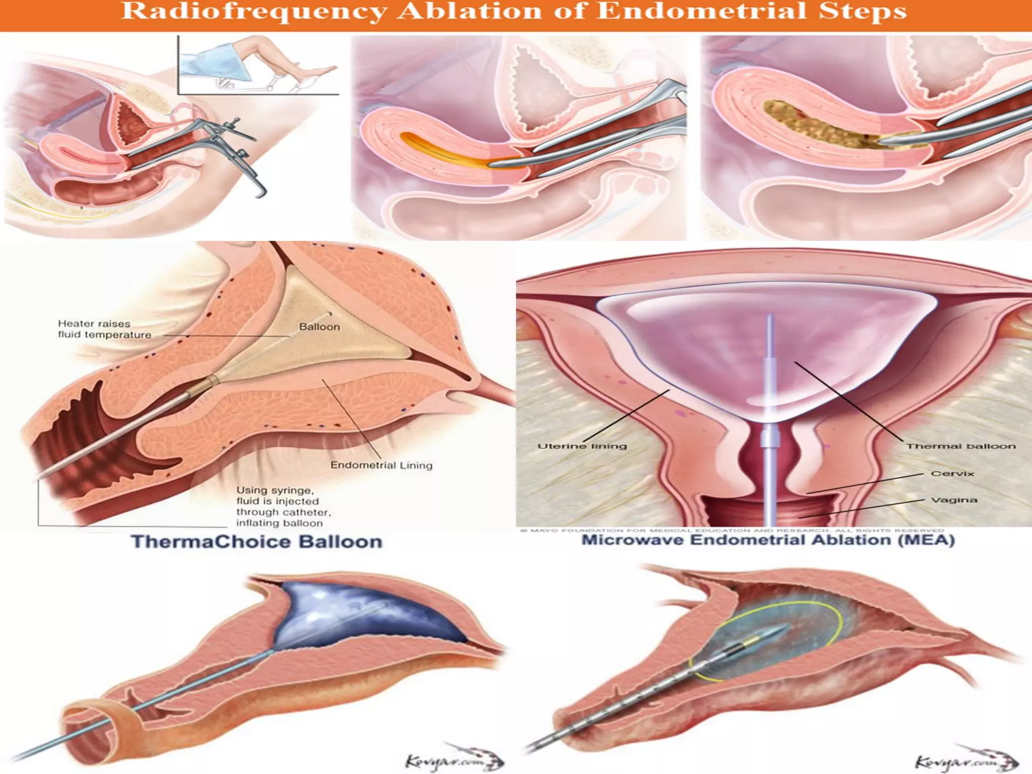 :Endometrial Ablation
 