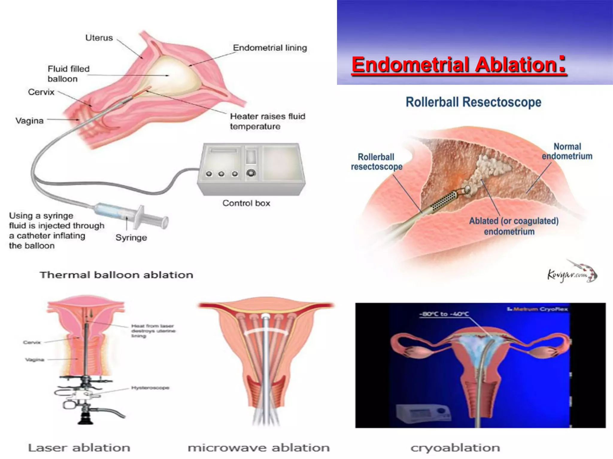 :Endometrial Ablation
 