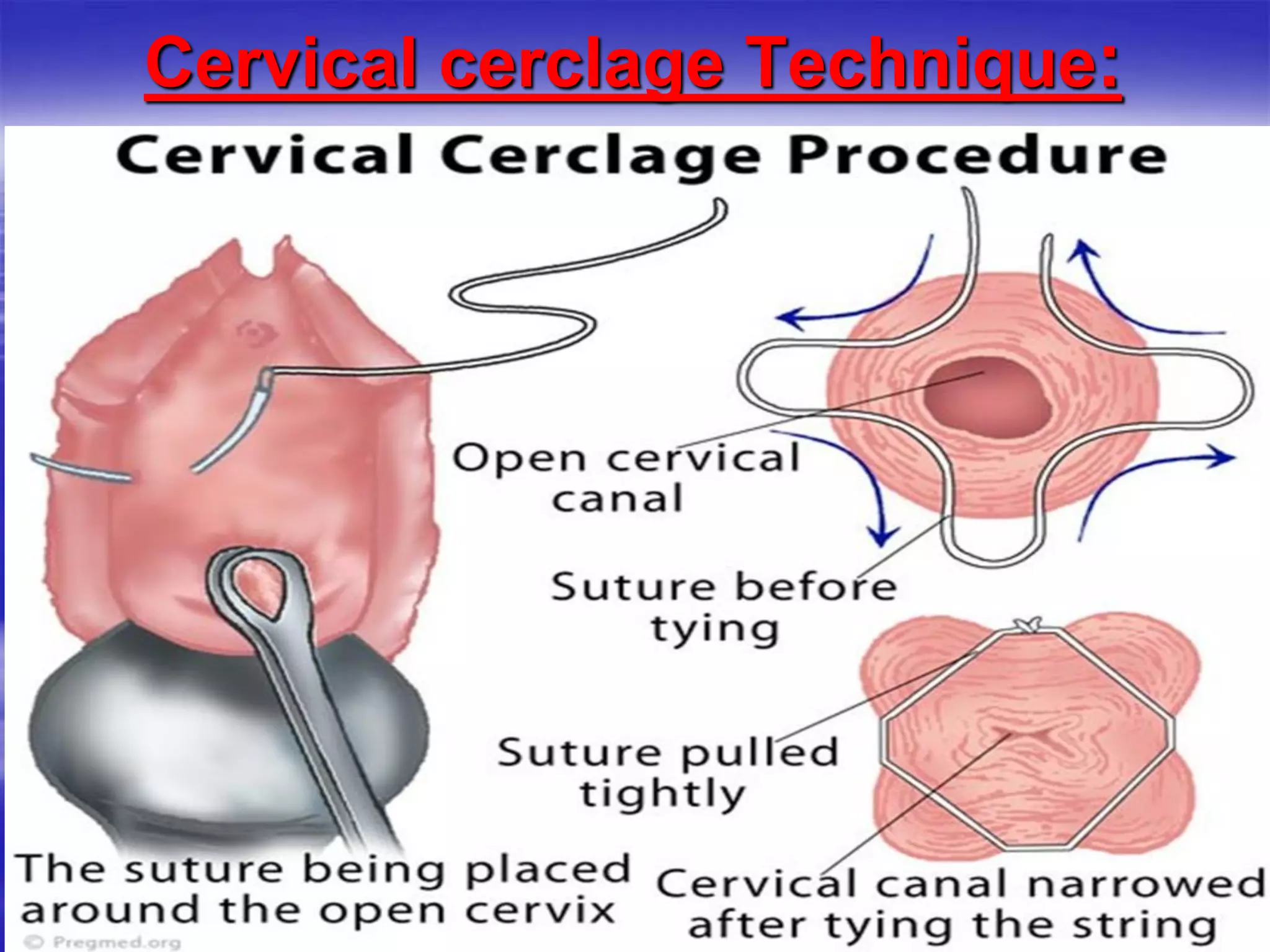 Cervical cerclage Technique:
:
 