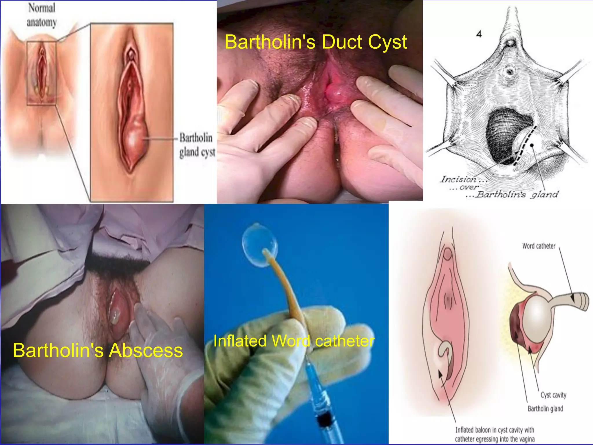 Bartholin's Duct Cyst
Bartholin's Abscess
Inflated Word catheter
 