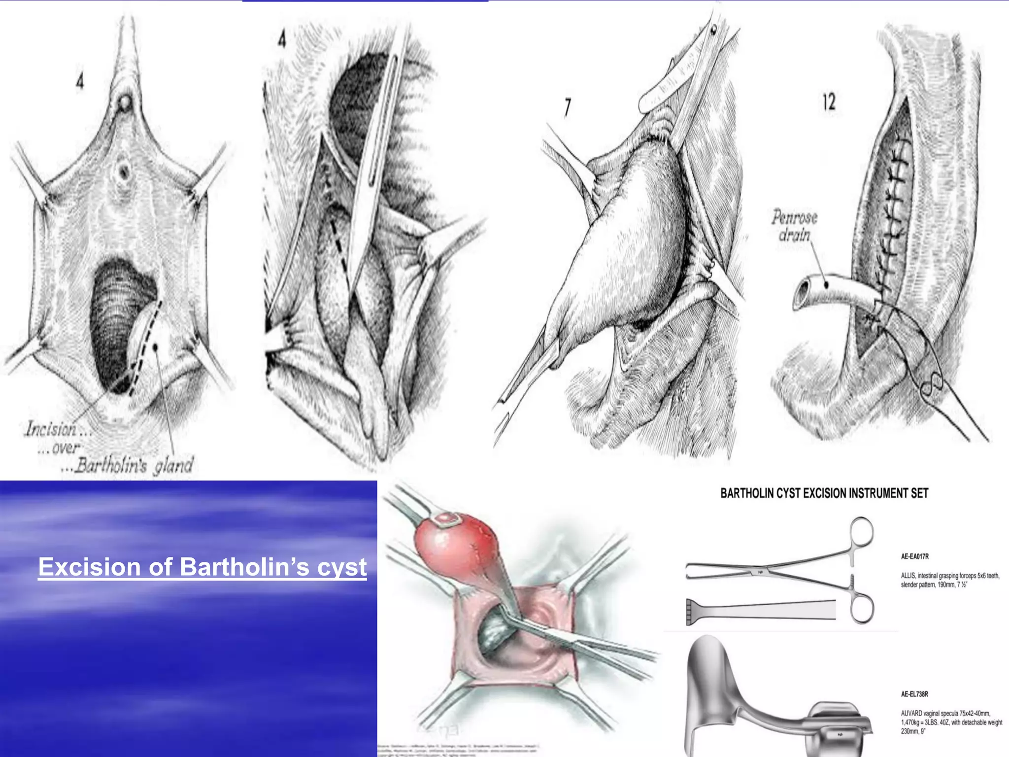 Excision of Bartholin’s cyst
 