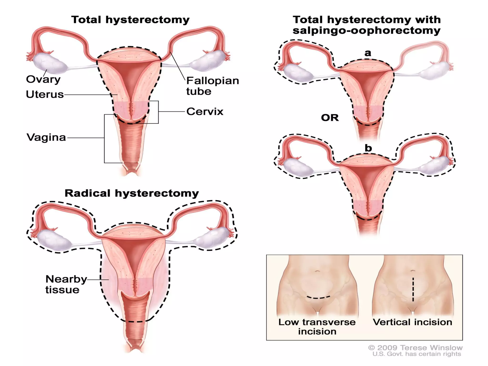 Abdominal Hysterectomy
 