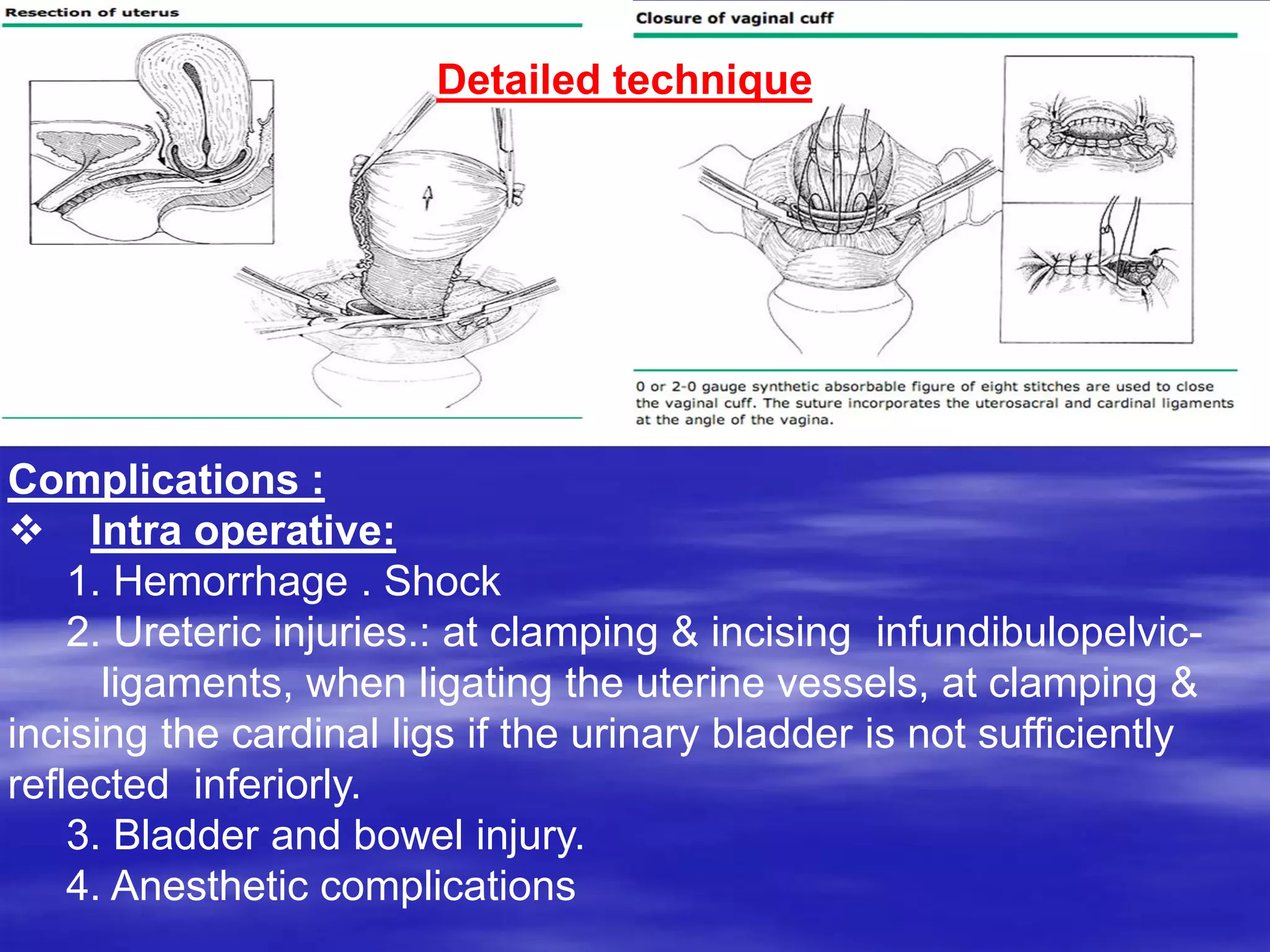 Detailed technique
Complications :
 Intra operative:
1. Hemorrhage . Shock
2. Ureteric injuries.: at clamping & incising infundibulopelvic-
ligaments, when ligating the uterine vessels, at clamping &
incising the cardinal ligs if the urinary bladder is not sufficiently
reflected inferiorly.
3. Bladder and bowel injury.
4. Anesthetic complications
 