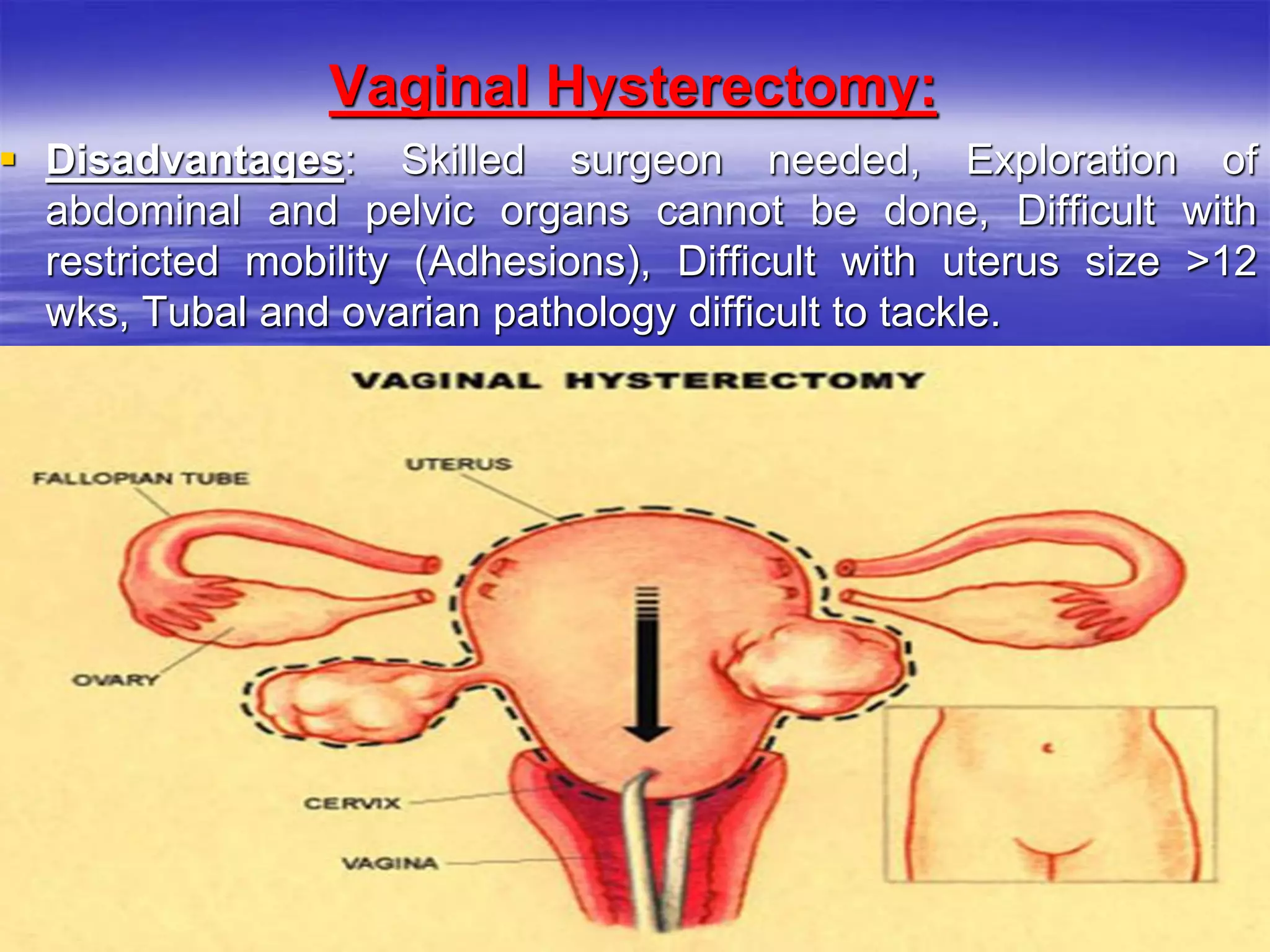 Vaginal Hysterectomy:
 Disadvantages: Skilled surgeon needed, Exploration of
abdominal and pelvic organs cannot be done, Difficult with
restricted mobility (Adhesions), Difficult with uterus size >12
wks, Tubal and ovarian pathology difficult to tackle.
I
 