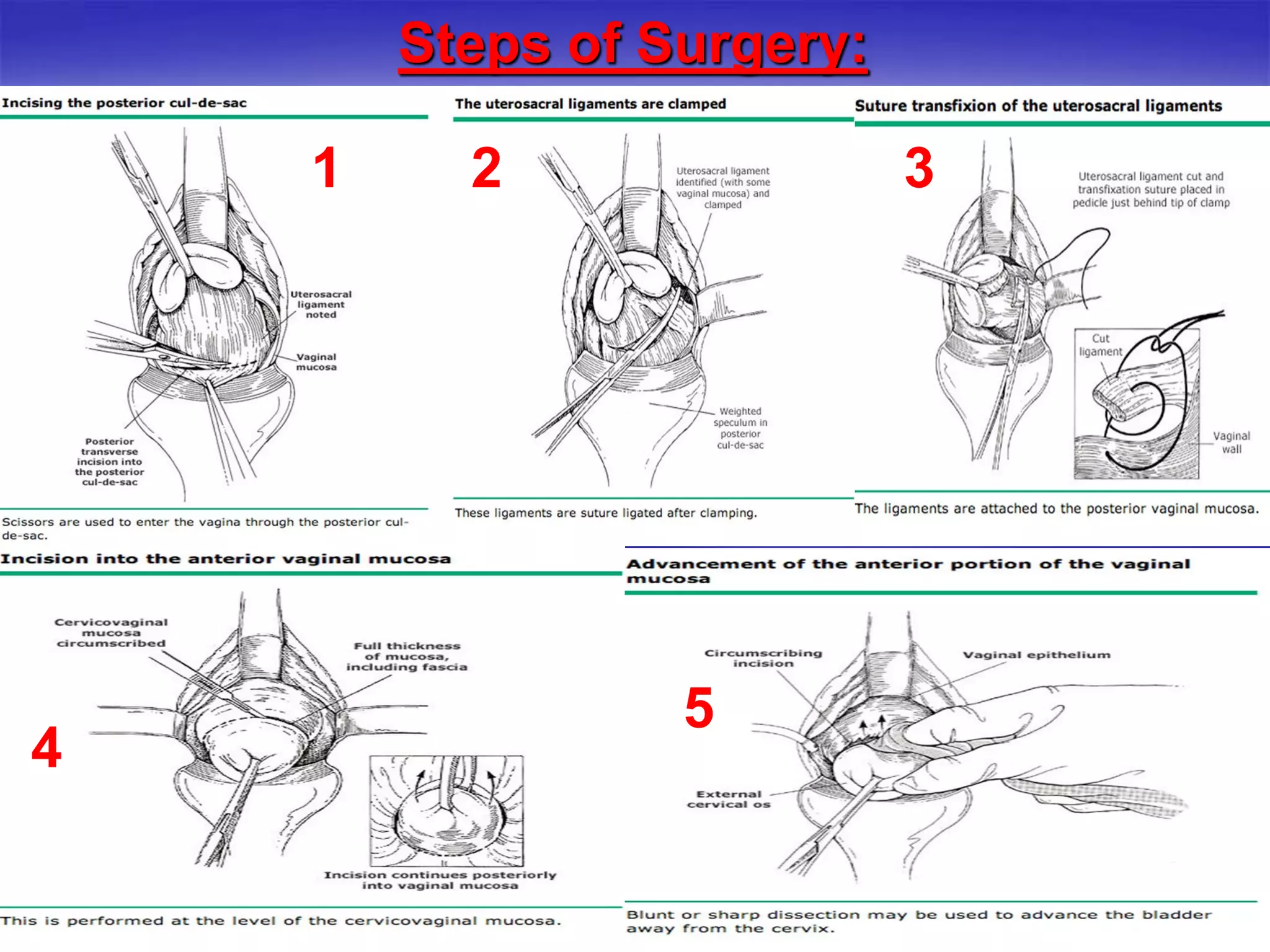 Steps of Surgery:
1
222
2 3
22
4
5
5
 