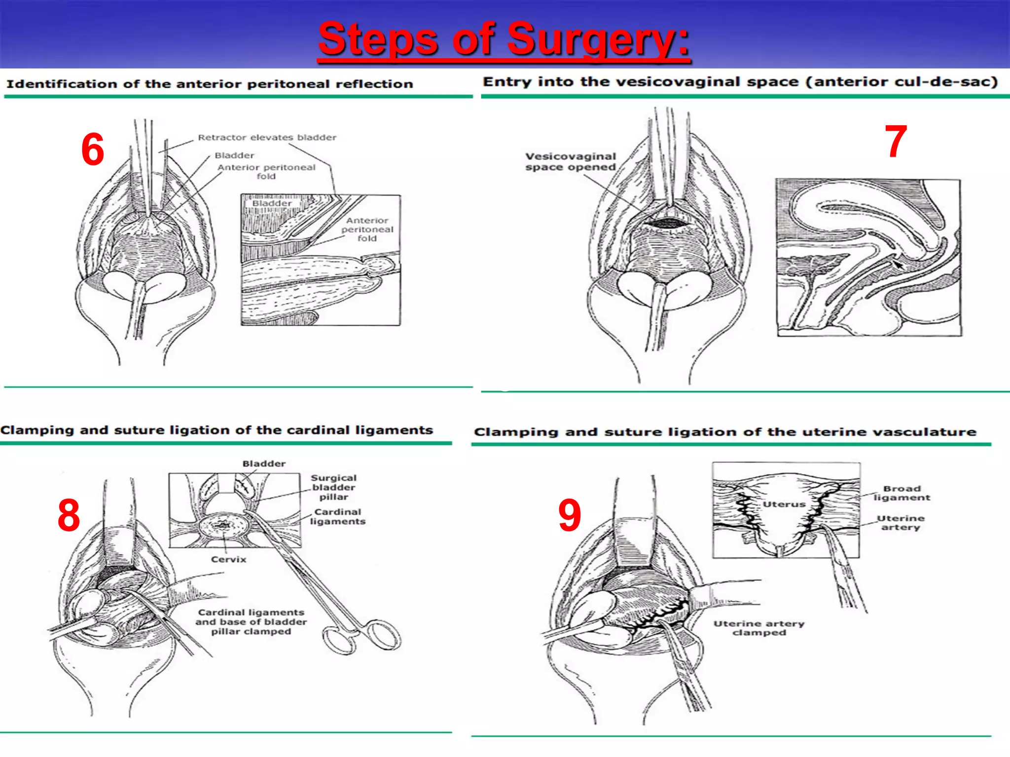 Steps of Surgery:
6 7
5
8 9
 