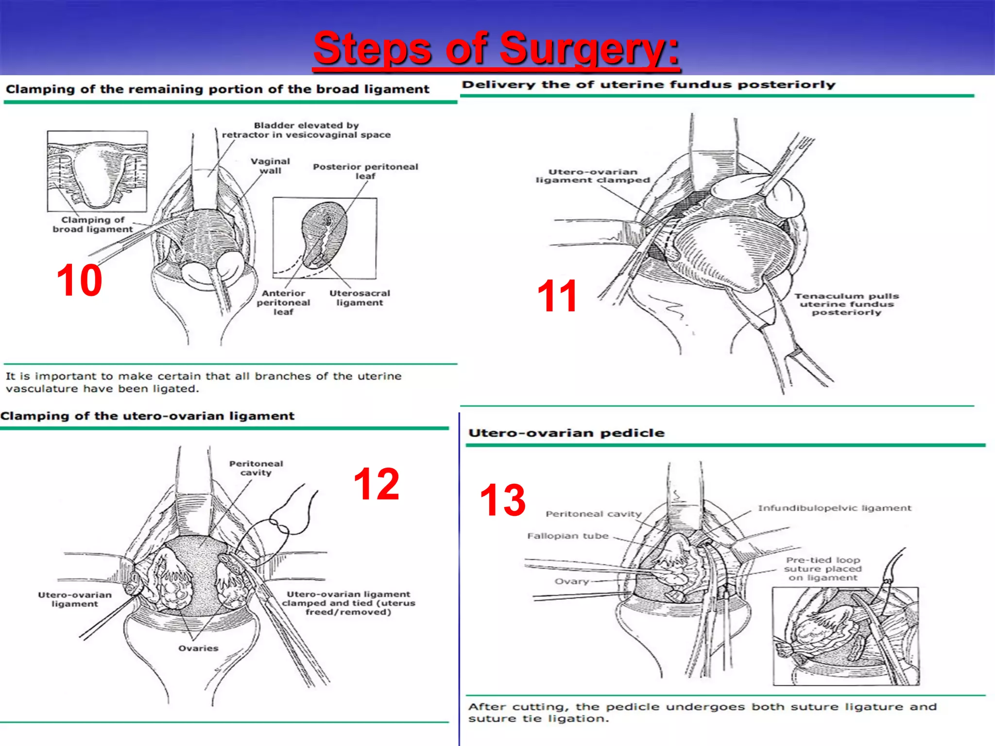 Steps of Surgery:
10 11
12
5
13
 