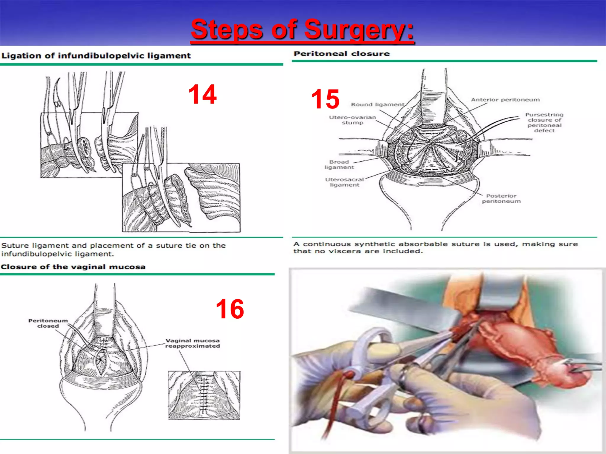 Steps of Surgery:
5
14
15
15
55
16
 