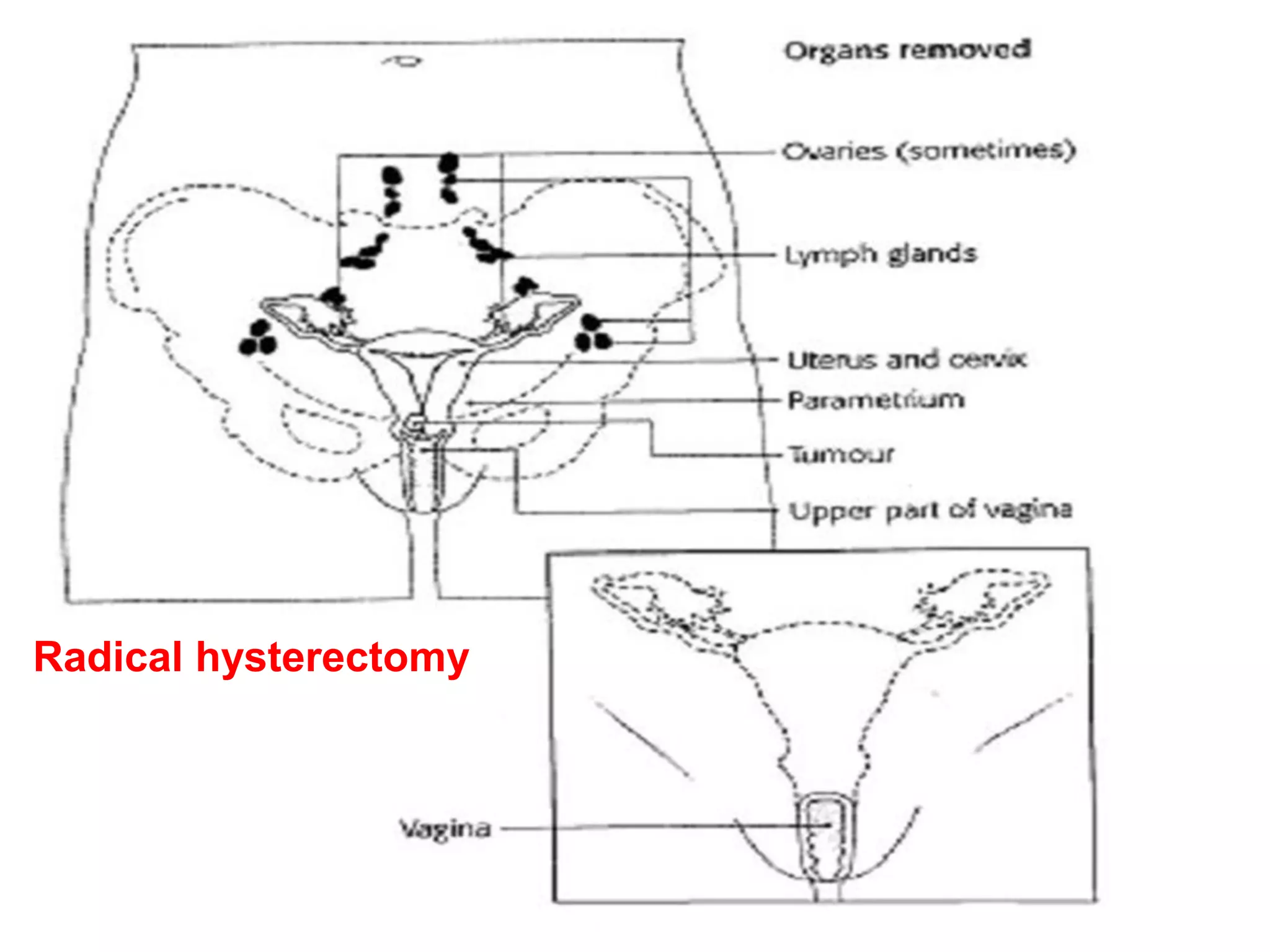 Radical hysterectomy
 