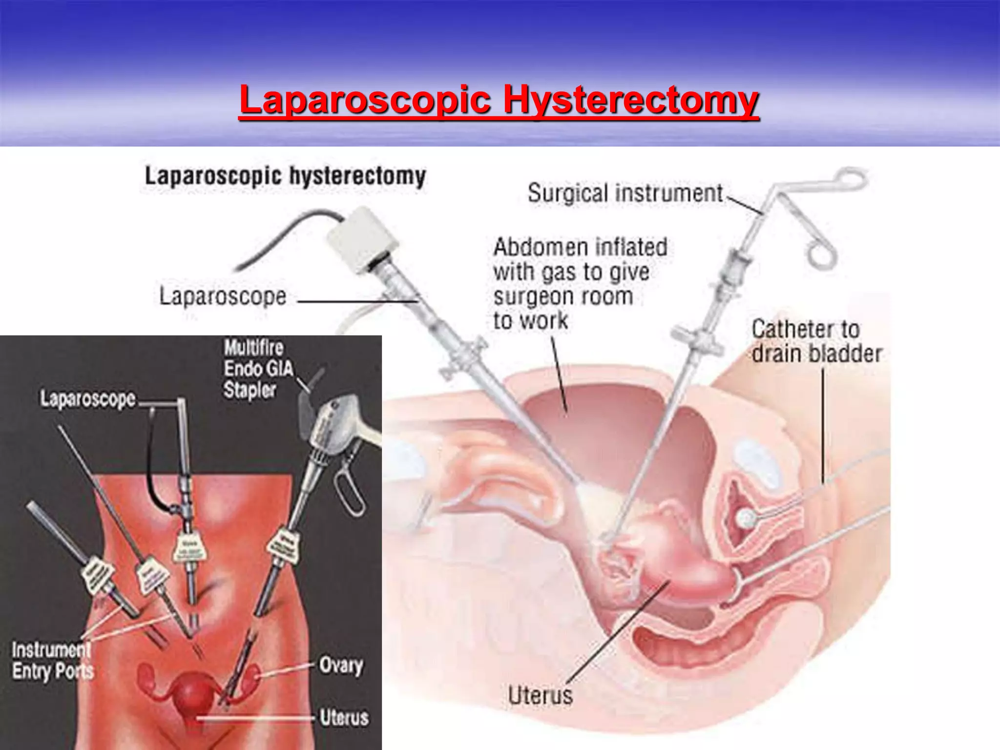 Laparoscopic Hysterectomy
 