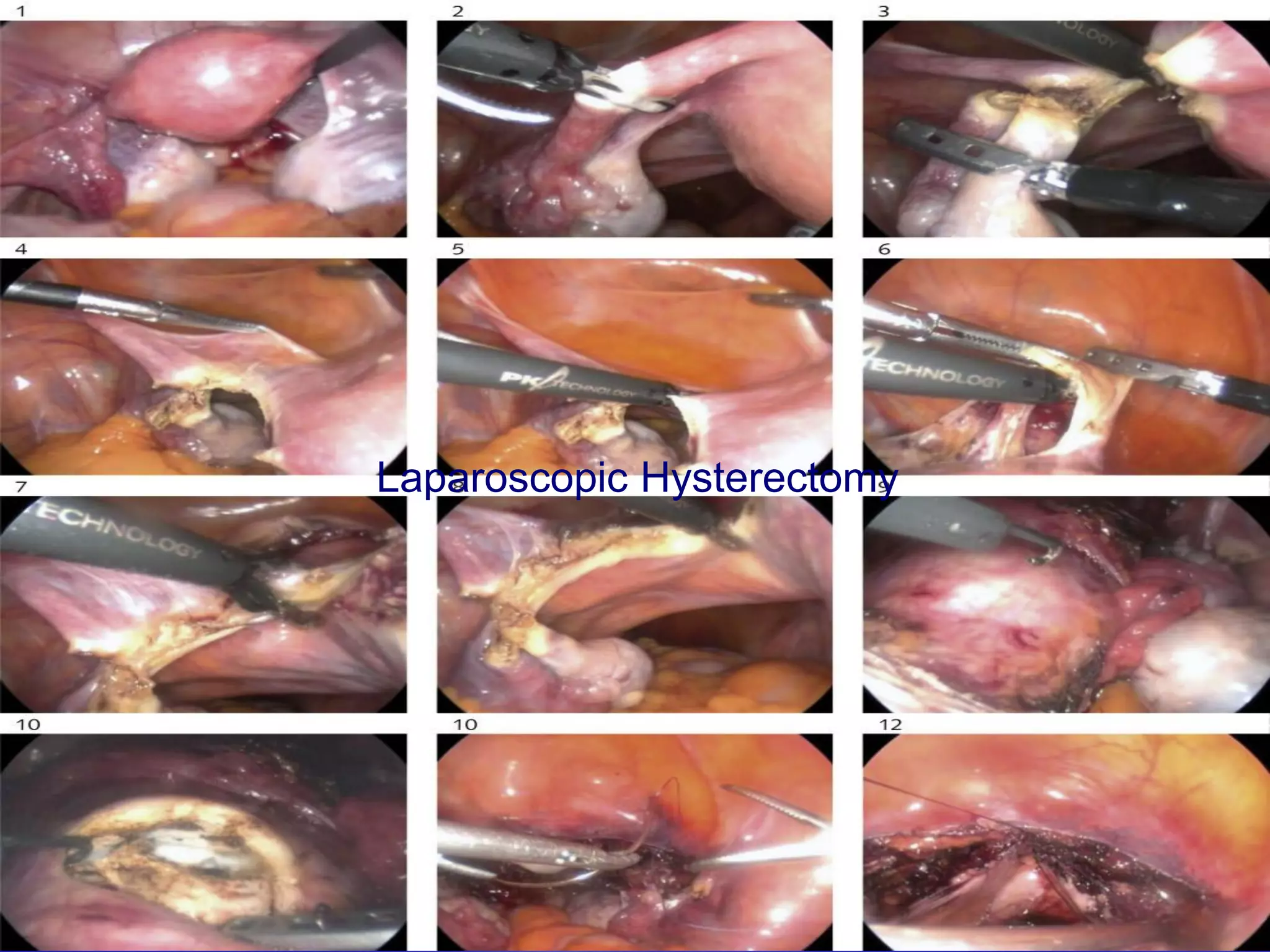 Laparoscopic Hysterectomy
Laparoscopic Hysterectomy
 