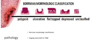 Boreman Classification Comprehensive Overview of Stomach Carcinoma: Diagnosis, Risk Factors ...