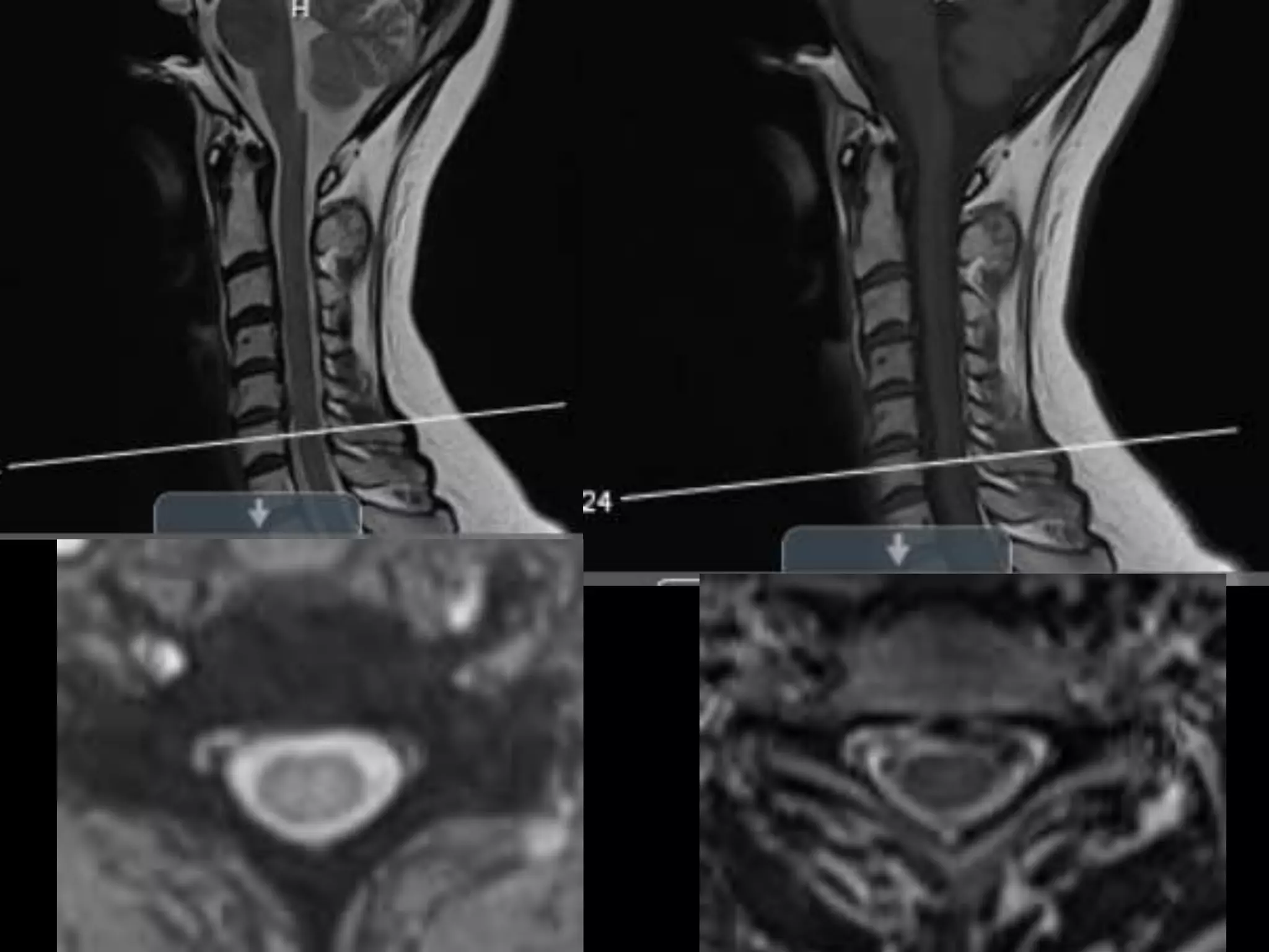 spine lecture cervical radiculopathy | PPT