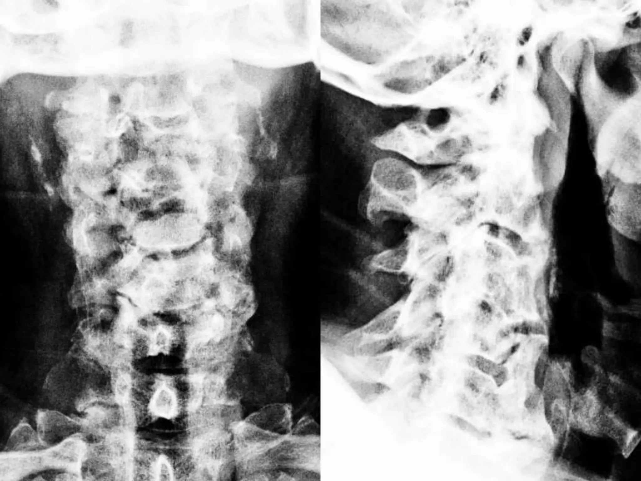 Lecture cervical stenosis DISH diffuse idiopathic skeletal hyperostosis ...