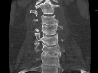 Lecture cervical stenosis DISH diffuse idiopathic skeletal hyperostosis ...