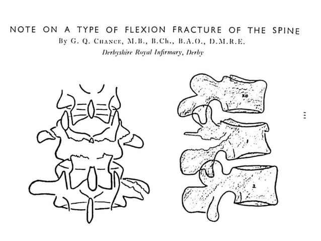 chance fractures of the spine | PPTX