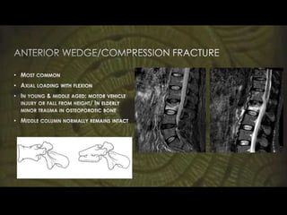 chance fractures of the spine | PPTX