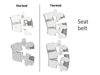 Chance Fracture