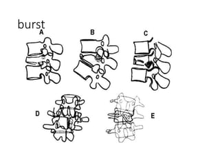 chance fractures of the spine | PPTX