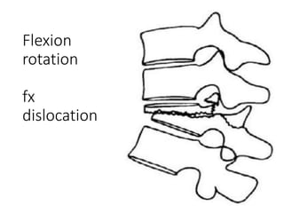 chance fractures of the spine | PPTX