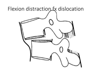chance fractures of the spine | PPTX