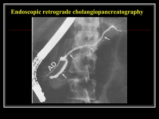 Endoscopic retrograde cholangiopancreatography
 