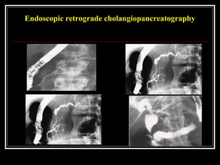Endoscopic retrograde cholangiopancreatography
 